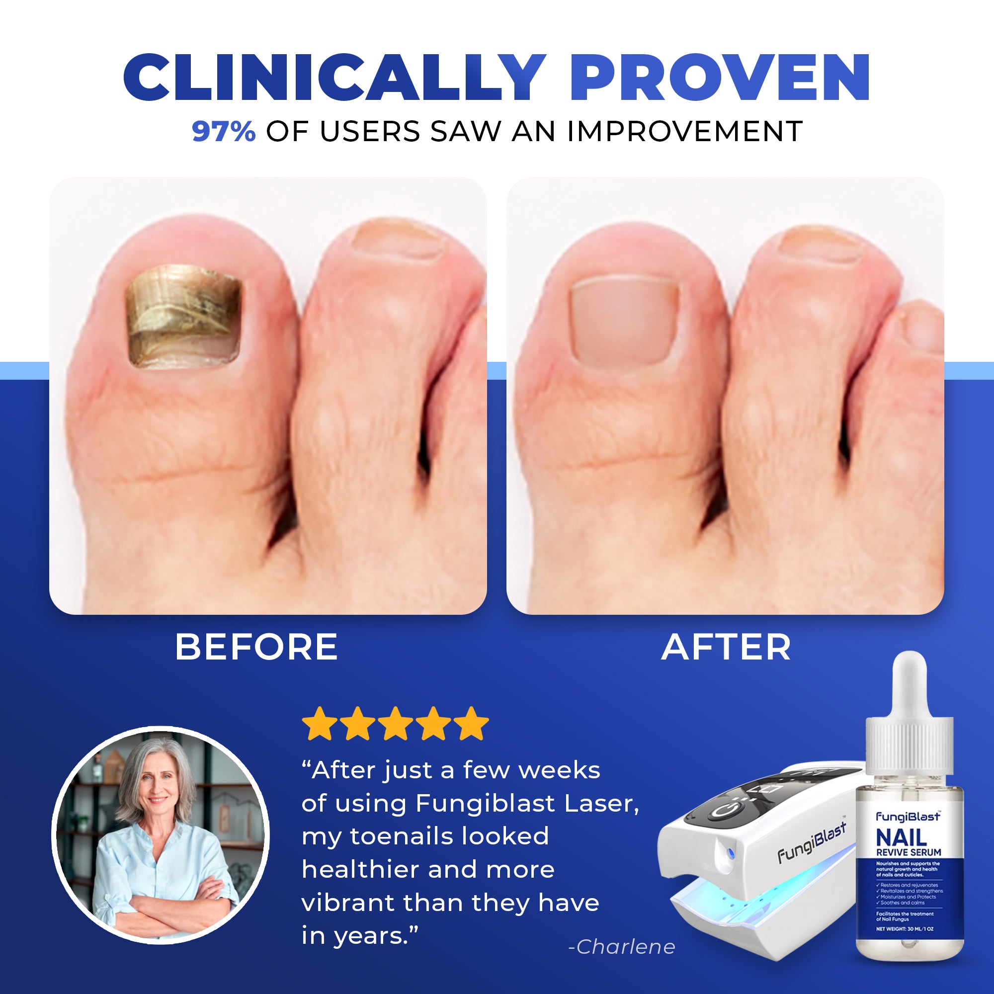 FungiBlast 21 Nail Fungus Laser Treatment Device & Serum Effective