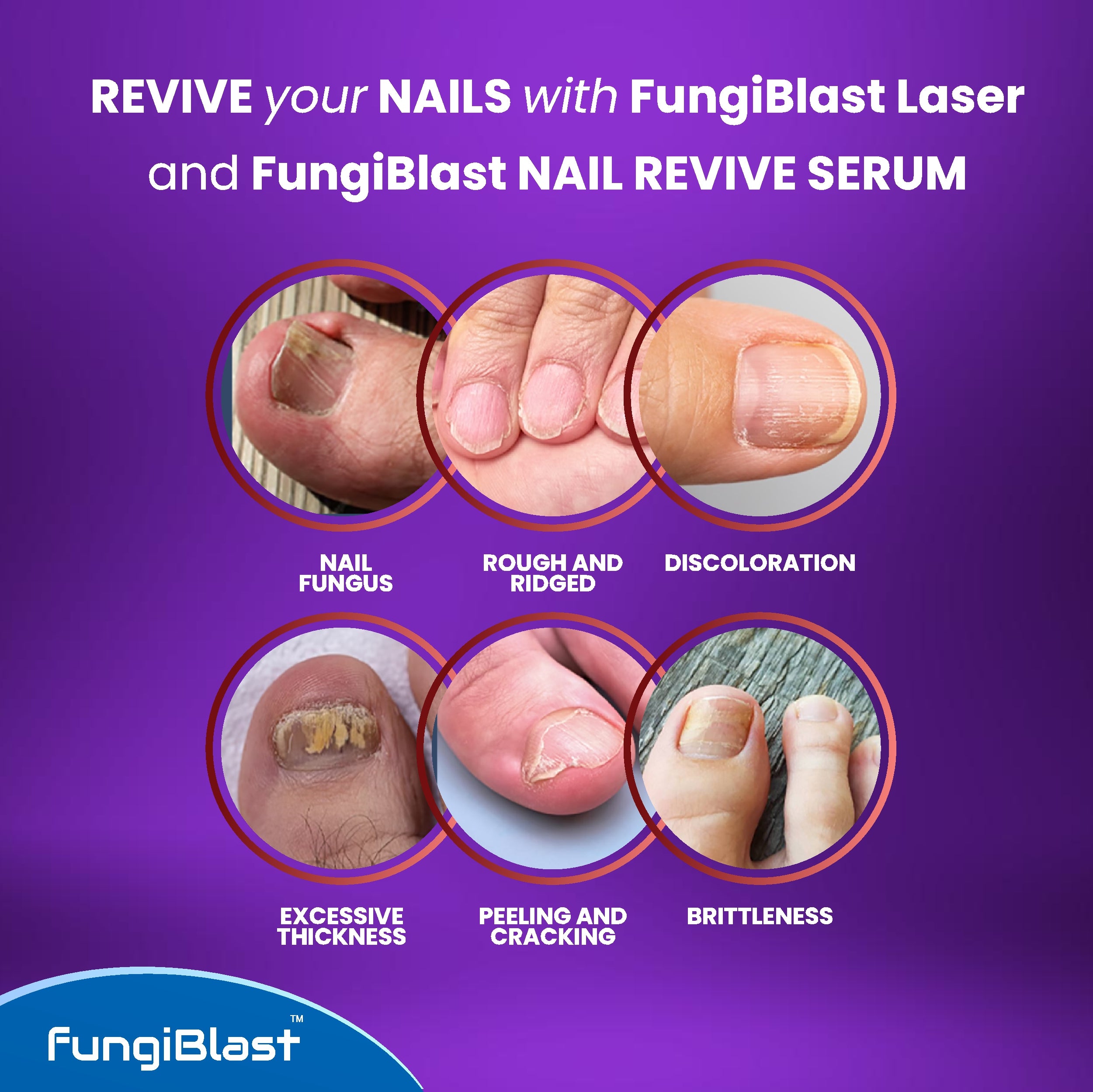 FungiBlast 21 Nail Fungus Laser Treatment Device & Serum Effective
